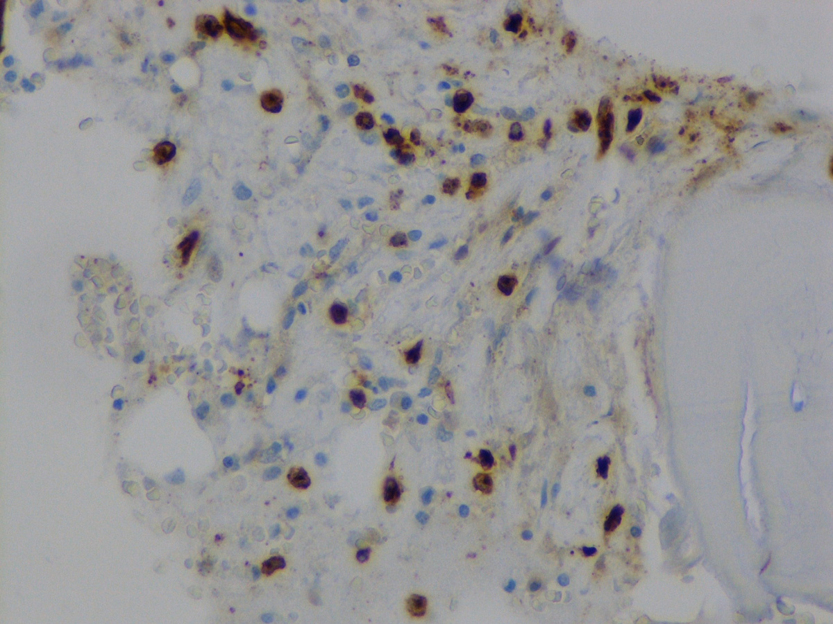 Bone marrow biopsy: CD34 immunostain #2